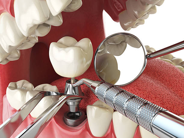 Best Emergency Root Canal Treatment in Odessa, FL